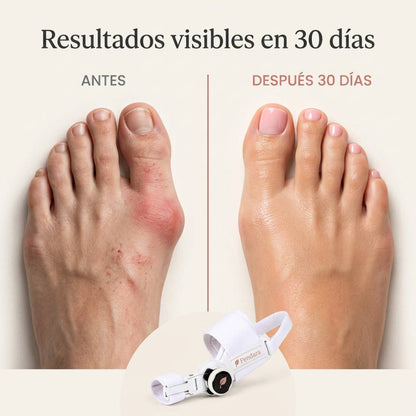 Vuelve a ponerte sandalias en 30 días — sin quirófano, sin dolor, desde tu sofá.